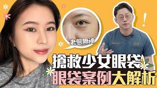 眼袋案例大解析！搶救少女眼袋｜周杰醫師