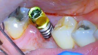  Full DENTAL IMPLANT PROCEDURE! Before and After - Extraction, Surgery, & Crown On Back Tooth Molar