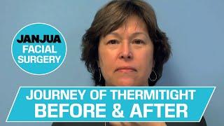 JOURNEY OF THERMITIGHT - BEFORE & AFTER - DR. TANVEER JANJUA - NEW JERSEY