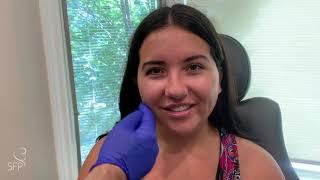 Buccal Fat Removal Surgery | 3 Weeks Before & After Results | by Dr. Philip Solomon