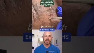 Derm reacts to severe armpit extractions! #dermreacts #doctorreacts #extraction