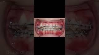 Niềng răng giữ răng khểnh #braces #orthodontist #niengrang