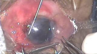 Step by Step Guide to Endothelial keratoplasty by Dr Charuta