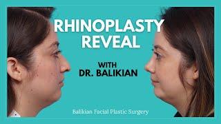 INCREDIBLE Rhinoplasty Reveal with Dr. Richard Balikian