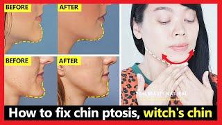 How to fix chin ptosis, witch's chin, chin correction, chin long, get beautiful chin without surgery