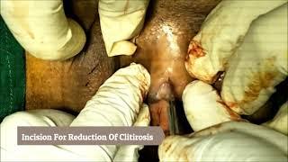 Clitoral Hood Reduction Also Termed Clitoral Hoodectomy, Clitoral Unhooding, Surat, Gujarat, India.