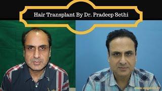 Hair Transplant in India Review | Mr. Rishi Shares His Hair Transplant Experience