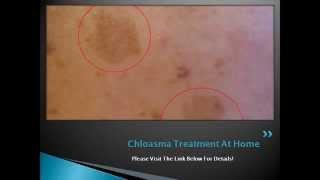 Chloasma Treatment At Home - How to Get Rid of Chloasma or Melasma Naturally