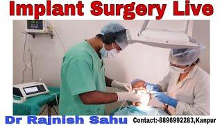 Dental Implants || Immediate Dental Implant || Live Surgery || @rajnishsahu82