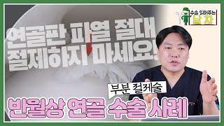 연골판 파열(물렁뼈 파열) 쉽게 절제하지 마세요. 큰일나요!｜반월상 연골 파열 부분 절제술 수술 케이스｜수술 읽어주는 남자‍️