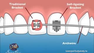 Vincent Team Orthodontics Self-Ligating Braces