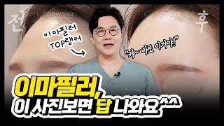 [뉴스타의원] 이마필러, cc를 많이넣는게 중요한게 아니다?‍️