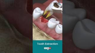 Tooth Extraction Procedure ↪ 3D Medical Animation #Shorts #Tooth #ToothExtraction