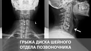 Грыжа диска шейного отдела позвоночника - симптомы и лечение