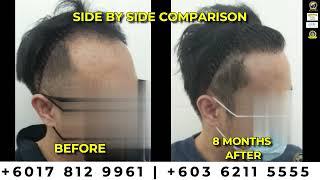 Before and After Hair Transplant: 8 Months Post SMART™ FUE at Glojas Clinic