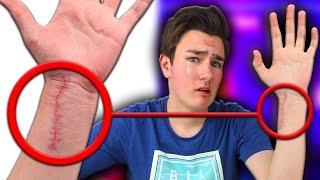 The Truth About TechSmartt's Wrist Scar...