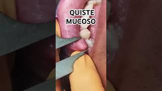 #shorts QUISTE Mucoso  Oral FIBROMA