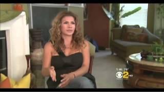 Botched breast implants corrected by Los Angeles plastic surgeon Dr. Steven Teitelbaum