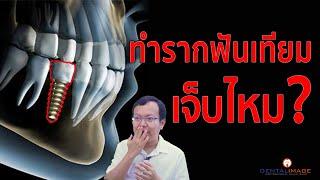 ทำรากฟันเทียม "เจ็บไหม?" | รากฟันเทียม By Dentalimage