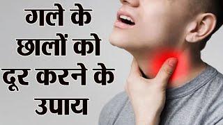 गले के छालों की समस्या से हैं परेशान तो करें ये घरेलू उपाय, मिलेगी राहत।  Remedies To Cure Mouth