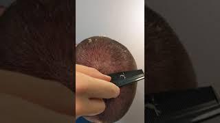 Scalp burn peeling