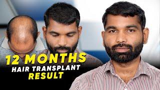 Hair Transplant in India | Best Results & Cost of Hair Transplant in India