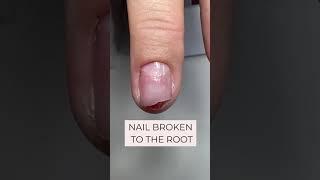 Nail broken to the root#shorts