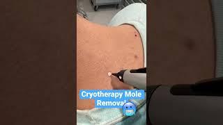 Cryotherapy MOLE REMOVAL Treatment ️