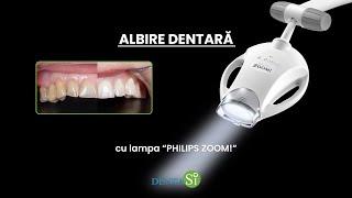 Albirea dentară cu lampa 'Philips Zoom!'