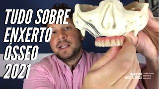 Como funciona o enxerto ósseo dentário  | Dr. Victor Hugo Almeida