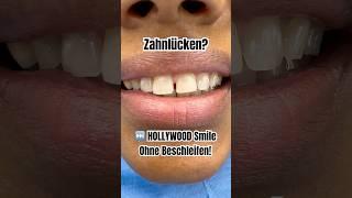 Von Zahnlücken zum HOLLYWOOD Smile! #hollywoodsmile #zahnlücke #flowableinjectiontechnique #veneers