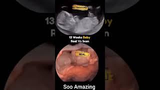13 week baby real vs scan