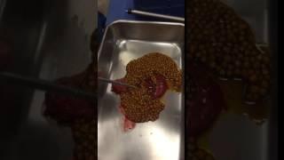 Gallbladder with multiple stones