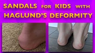 Sandals for Kids with Haglund's Deformity - Extra Padding and Cushion Around the Heels