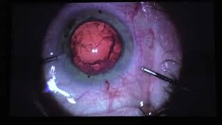 Факоэмульсификация катаракты с имплантацией ИОЛ Энвиста Торик с использованием Stellaris Elite и сис