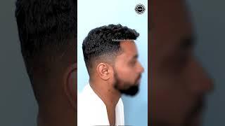 Transform Your Look: Amazing Hair Transplant Results | Dadu Medical Centre