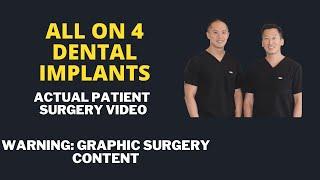 All on 4 Dental Implant Patient Surgery Video. How We Plan and Perform the Surgery
