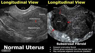 Uterus Ultrasound Normal Vs Subserosal Fibroid Images | Uterine Leiomyomas Cases | Pelvic USG Cases