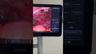 Robotic hernia surgery in delhi #7428617074