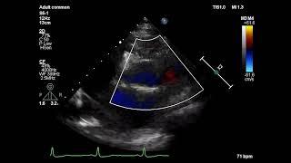 Asvide: Color Doppler flow imaging showed reverse flow in the left coronary artery.