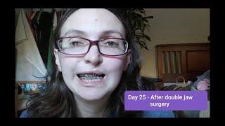 Double Jaw Surgery Day 25 - Corrective cleft lip and palate surgery