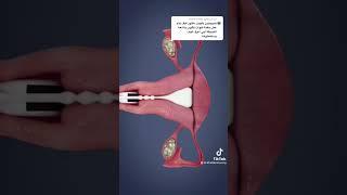 أشعة بالصبغة علي الرحم #learning #medical #اشعة #reels #how #shortvideo #shorts #shor #reel