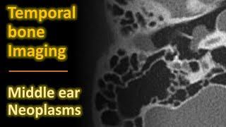 Temporal Bone Imaging - Glomus tympanicum & other middle ear neoplasms