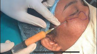 Under eye fat grafting|Indore|mumbai|zenith clinic|Dr Sumeeet Jaiswal