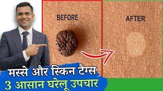 24 घंटे में मस्से को जड़ से मिटाए | Skin Tags And Warts will disappear in 24 Hours