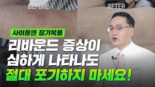 사이폴엔 면역억제제 장기복용으로 인한 리바운드 증상, 그래도 포기하지마세요!