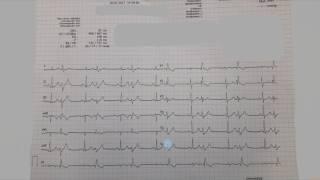 Ecg Shot z 05.07.2017