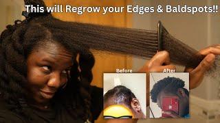 Use This Twice a Week and Your Hair Will Never Stop Growing| DIY for EDGES REGROWTH & BALDING‼️