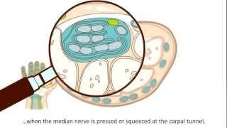 Carpal Tunnel Syndrome (CTS) - What is Carpal Tunnel Syndrome and how is it treated?