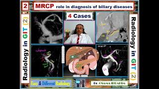 MRCP role in diagnosis of biliary system (2nd video from Radiology in GIT)